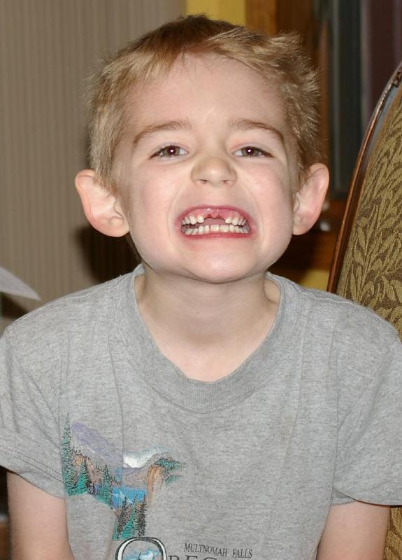 Two Teeth Out.jpg